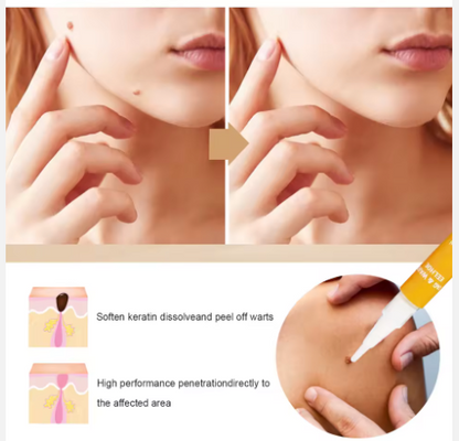 LAPIZ REMOVEDOR DE LUNARES Y VERRUGA